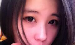 超声波双眼皮让我和单眼皮说拜拜859 超声波双眼皮让我和单眼皮说拜拜859