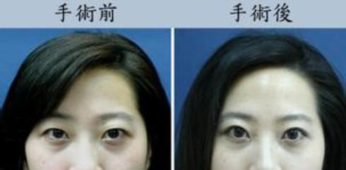 做了超声波双眼皮变年轻906 做了超声波双眼皮变年轻906