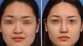 玻尿酸复合成骨因子注射隆鼻让wǒ拥有完美侧颜 玻尿酸复合成骨因子注射隆鼻让wǒ拥有完美侧颜