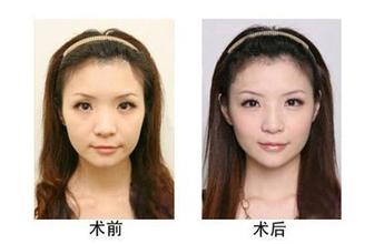 超声波自体脂肪丰面比玻尿酸丰面要先进049 超声波自体脂肪丰面比玻尿酸丰面要先进049
