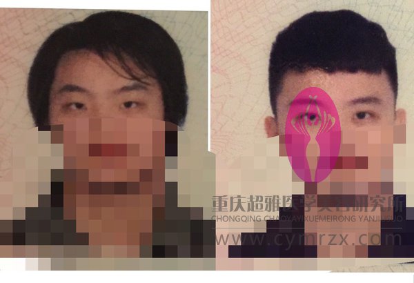 纠结的我终于割了双眼皮!803 纠结的我终于割了双眼皮!803