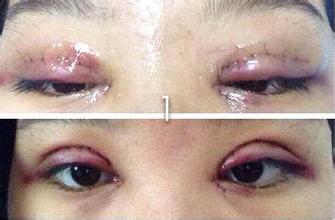 开刀双眼皮的并发症真的太明显了