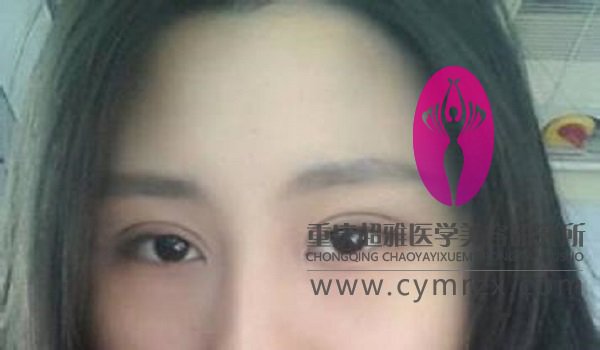 做过埋线双眼皮才知超声波双眼皮的好942 做过埋线双眼皮才知超声波双眼皮的好942