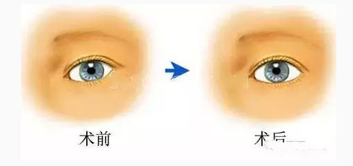 超声波双眼皮不用开刀就能形成双眼皮672