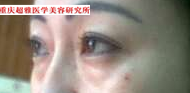 千万别做假冒的超声波去眼袋!201 千万别做假冒的超声波去眼袋!201