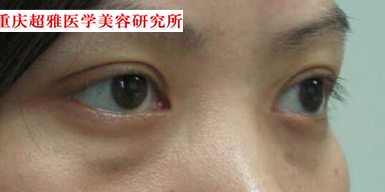 去眼袋其实可以无痛苦!248 去眼袋其实可以无痛苦!248