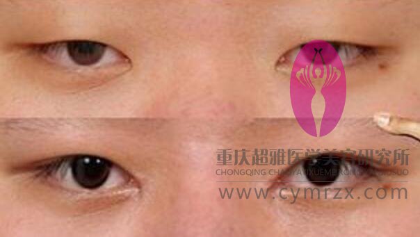 超声波双眼皮改变了我的形象418 超声波双眼皮改变了我的形象418