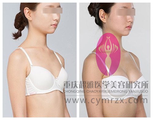 有什么隆胸手术是既安全又无痛无痕的呢?765 有什么隆胸手术是既安全又无痛无痕的呢?765