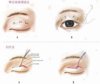与韩式连续埋线法和切开双眼皮相比，超声波双眼皮更优秀137