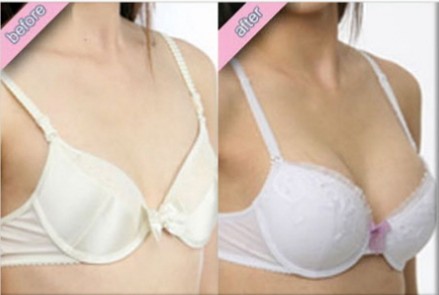 超雅整形医院的隆胸手术让朋友不开刀就能丰胸美乳742