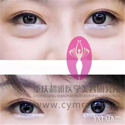 不开刀去眼袋认准超雅正宗的超声波去眼袋849 不开刀去眼袋认准超雅正宗的超声波去眼袋849
