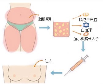 自体脂肪丰胸的常规步骤有哪些?487 自体脂肪丰胸的常规步骤有哪些?487