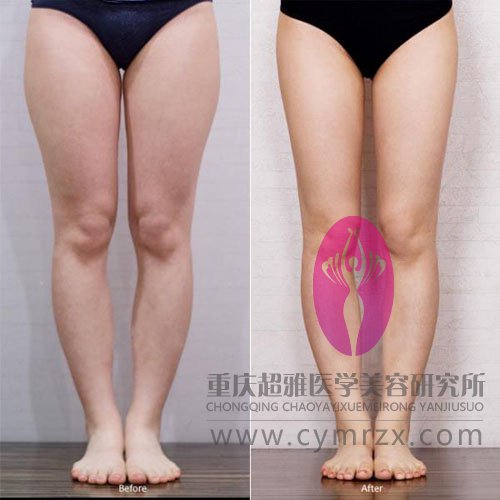 超声波自体脂肪丰胸减肥塑造好身材098 超声波自体脂肪丰胸减肥塑造好身材098