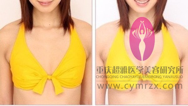 超声波自体脂肪丰胸减肥塑造好身材098 超声波自体脂肪丰胸减肥塑造好身材098