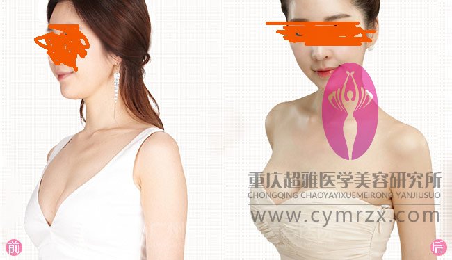 超 声 波自体脂肪丰胸——让出轨得老公回归家庭 超 声 波自体脂肪丰胸——让出轨得老公回归家庭