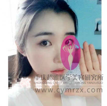 超声波双眼皮帮我打造了小清新款双眼皮,看图250 超声波双眼皮帮我打造了小清新款双眼皮,看图250
