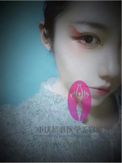 超声波双眼皮帮我打造了小清新款双眼皮,看图250 超声波双眼皮帮我打造了小清新款双眼皮,看图250
