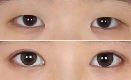 怎样变成双眼皮答案就在这里676 怎样变成双眼皮答案就在这里676