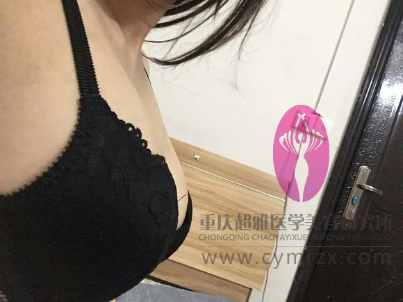 已经做le超 声 波自体脂肪丰胸le，还在恢复阶段