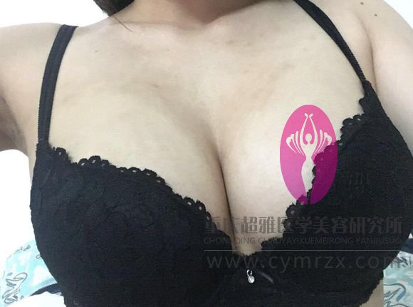 已经做le超 声 波自体脂肪丰胸le，还在恢复阶段