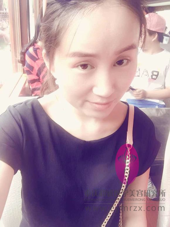 有没有姐妹和我一样做过超声波自体脂肪丰胸啊？177