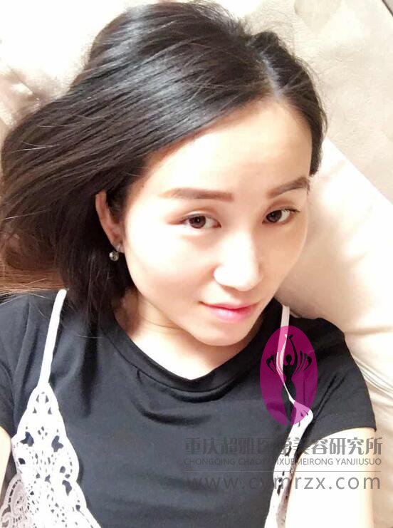 有没有姐妹和我一样做过超声波自体脂肪丰胸啊？177