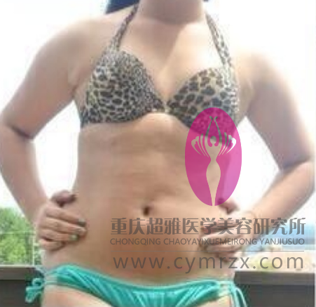 感谢超声波减肥,让我重新变得自信美丽507 感谢超声波减肥,让我重新变得自信美丽507