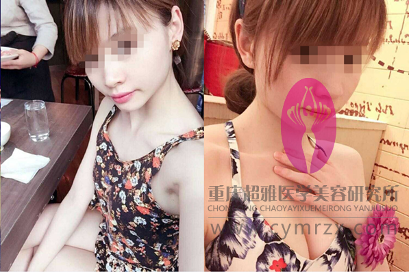 超声波自体脂肪丰胸后，大家都说我的胸部好好看呢624