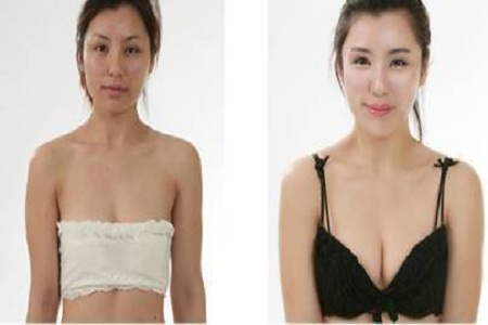 超 声 波自体脂肪丰胸改身lewǒ得身材