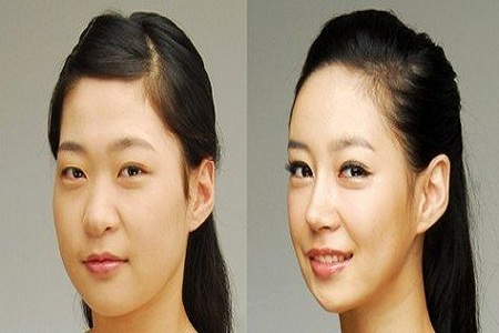 割双眼 皮需要多少钱呢?答案都在这里 割双眼 皮需要多少钱呢?答案都在这里