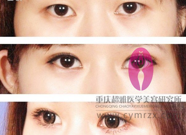 双眼皮手术好不好,效果是王道681 双眼皮手术好不好,效果是王道681