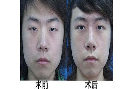 小编告诉你怎样变成双眼皮833 小编告诉你怎样变成双眼皮833