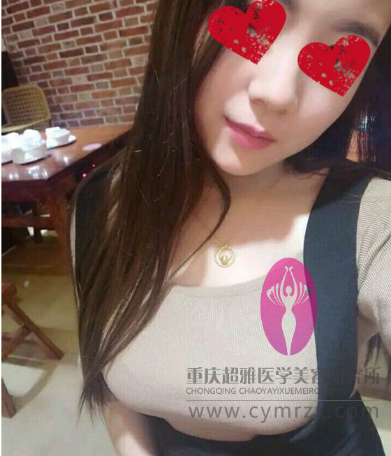 wǒshì重庆美眉，分享下在重庆超雅做超 声 波自体脂肪丰胸经历