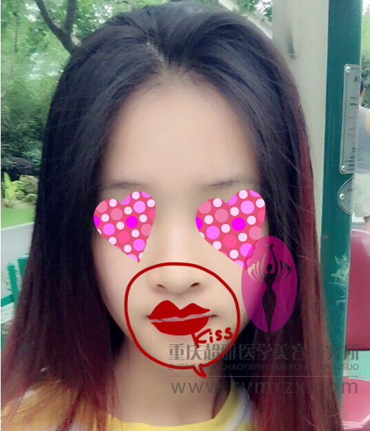 wǒshì重庆美眉，分享下在重庆超雅做超 声 波自体脂肪丰胸经历