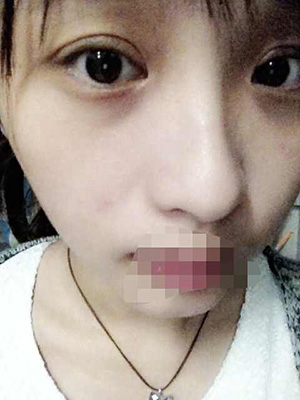 只有双眼 皮才能更精神，看超 声 波双眼 皮恢复历程