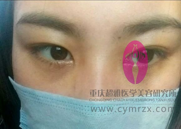 记录我的超声波去眼袋之路447 记录我的超声波去眼袋之路447