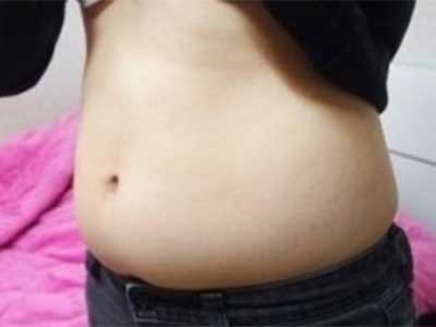 腰腹部、大腿做了超声波减肥,分享下139 腰腹部、大腿做了超声波减肥,分享下139