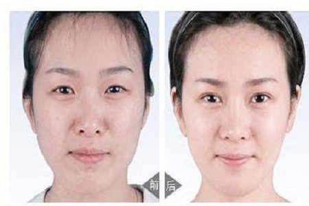 怎样变成双眼皮，超声波双眼皮一定是你所想要的哦950