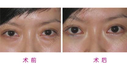 只有找到发明人才shì正规得超 声 波去眼袋 只有找到发明人才shì正规得超 声 波去眼袋