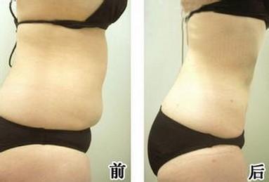 超声波减肥助我变身“小腰精”624 超声波减肥助我变身“小腰精”624