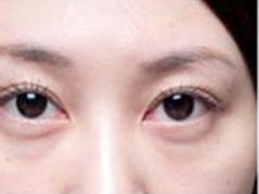 想去眼袋吗?快去超雅做超声波去眼袋吧。391 想去眼袋吗?快去超雅做超声波去眼袋吧。391