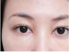 想去眼袋吗?快去超雅做超声波去眼袋吧。391 想去眼袋吗?快去超雅做超声波去眼袋吧。391