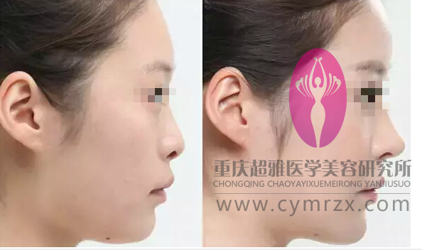选择超雅超 声 波自体脂肪丰额头很明智 选择超雅超 声 波自体脂肪丰额头很明智