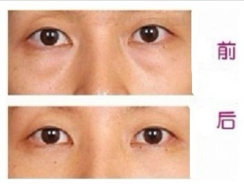 有眼袋问题就交给超 声 波去眼袋吧 有眼袋问题就交给超 声 波去眼袋吧