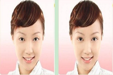 超声波双眼皮拯救了我759 超声波双眼皮拯救了我759