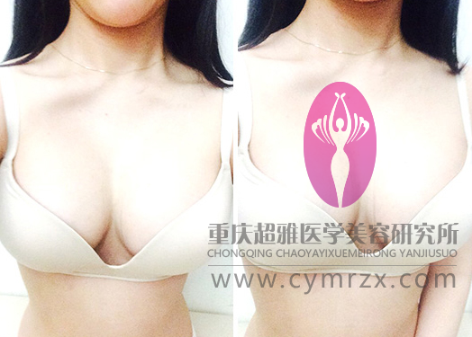 超声波自体脂肪丰胸——给我的惊艳改变413 超声波自体脂肪丰胸——给我的惊艳改变413