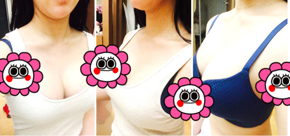 超声波自体脂肪丰胸——给我的惊艳改变413 超声波自体脂肪丰胸——给我的惊艳改变413