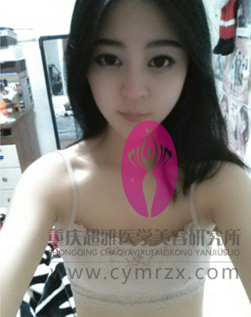 穿衣无胸怎么办？超声波自体脂肪丰胸让你再无遗憾470