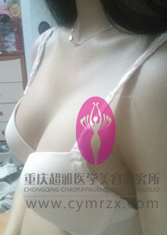 穿衣无胸怎么办？超声波自体脂肪丰胸让你再无遗憾470