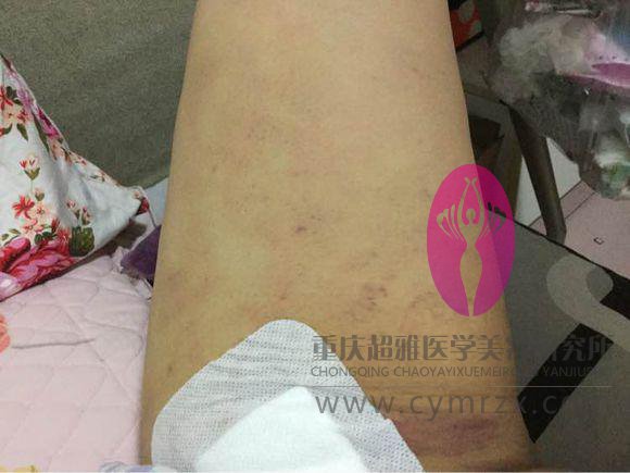拒绝抽脂,wǒ要超 声 波减肥 拒绝抽脂,wǒ要超 声 波减肥